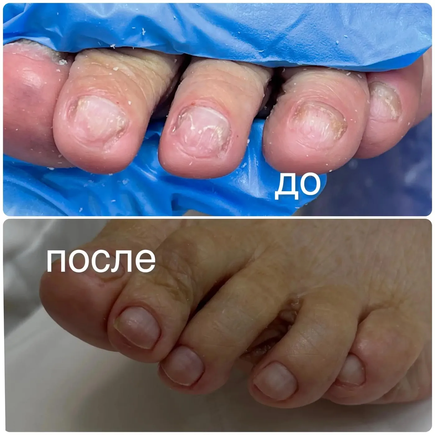 До и после обработки ногтей — пример работы подолога в Серпухове